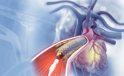 Heart Surgery